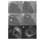 Different Intravascular Ultrasonograms Obtained from the Site of an Accordion Phenomenon before and after Distal Stenting