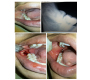 Horizontally Impacted Mandibular Third Molar