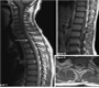 Magnetic Resonance Imaging of the Spine in HIV-associated Tuberculous Meningitis Immune Reconstitution Syndrome presenting as Myeloradiculopathy