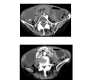 Torsion of the Gallbladder