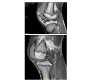 Knee Swelling in a Teenager - Infection, Inflammation or Malignancy?