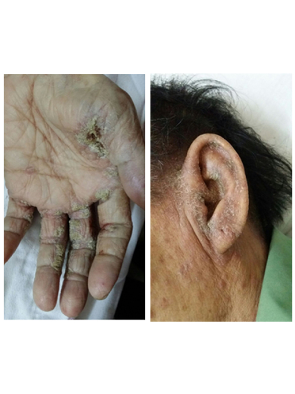 Norwegian Crusted Scabies International Journal Of Clinical