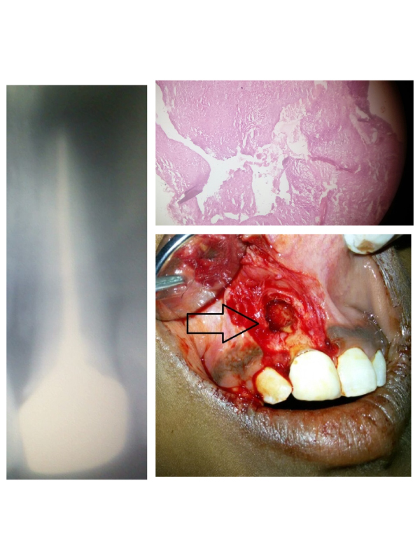 Radicular Cyst | International Journal of Clinical & Medical Images