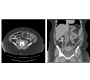 Idiopathic Ovarian Vein Thrombosis in a Healthy Individual