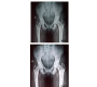 Symphysis Pubis Diastasis