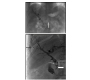 Lithotripsy of Biliary Calculi in a Complex Biliary Tract Using Endourologic Equipment