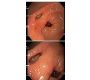 Double Pylorus Sign in a Cirrhotic: A Rare Endoscopic Finding