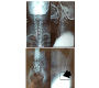 Spondylolisthesis Grade III