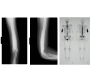 Sclerosing Osteomyelitis in the Long Bone