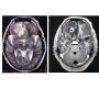 Neurocysticercosis