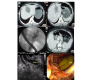 Myriad Imaging Appearances of Biliary Hydatidosis