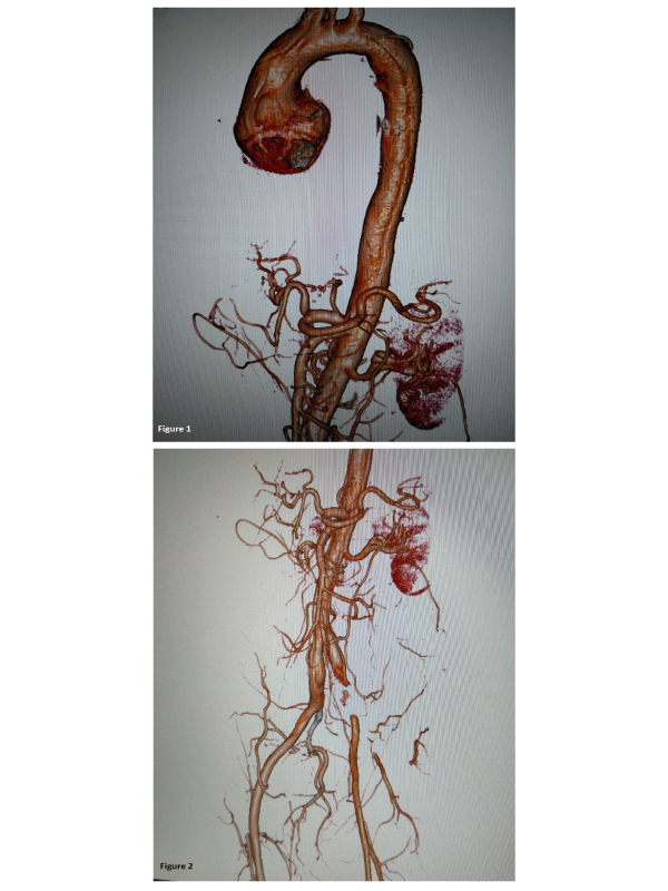 Acute Ascending Aortic Dissection