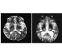 MRI Findings of the Japanese Encephalitis