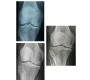 Effectiveness of Ozone in Osteoarthritis of the Knee