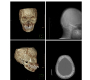 Severe Secondary Hyperparathyroidism