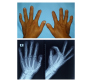 Band-like Acral Osteolysis in Limited Cutaneous Scleroderma