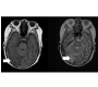 Nocardia Brain Abscess in a Patient of Lung Cancer