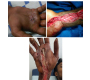 Industrial High-Pressure Gun Injection Injury of Hand