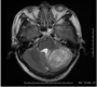 H-Mr Spectroscopy in Lhermitte–Duclos Disease: Axial T2-Weighted 