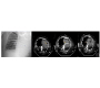 A Pleural Catheter Malposition through Mediastinum to Contralateral Hemithorax: An Interesting Image