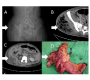 Perforated Colon Cancer Complicated with Necrotizing Fasciitis