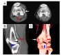 Cold Limb in Blunt Knee Injury