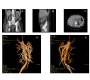 Intra-hepatic Atherosclerosis Disease: An Incidental Finding in Acute Abdominal Pain Patient