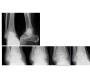 Ankle Joint Damage Treated with Infliximab in a Patient with Rheumatoid Arthritis