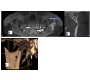 Parotid Stafne Defect