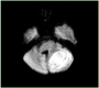 Assessment with MR Imaging: Diffusion-Weighted Image