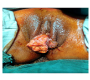 Vulval Tuberculosis Mimicking Malignancy ï¿½ A Diagnostic Dilemma