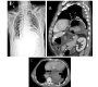 Perforated Gastric Ulcer in an Incarcerated Hiatal Hernia