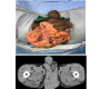 Massive Verrucous Squamous Cell Carcinoma of the Perineum