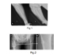 Atypical Femoral Fracture