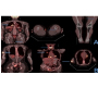 A Rare Metastasis of Lung Carsinoma Detected with PET/CT