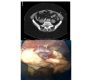 Treatment of Epiploic Appendigitis Using Laparoscopic Electrocautery Technique