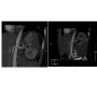 An Unusual Presentation of Fibromuscular Dysplasia