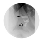 A Spiral Stomach after Vertical Sleeve Gastrectomy