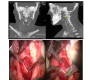 Temporomandibular Joint Pain Radiating to Neck Leading to Eagleï¿½s Syndrome