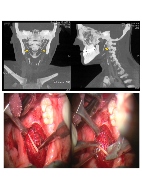 Temporomandibular Joint Pain Radiating to Neck Leading to Eagleï¿½s Syndrome
