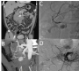 Transcatheter Embolization for Ruptured Aneurysm of Pancreaticoduodenal Artery