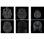 A Massive Cerebral Venous Thrombosis Secondary to Facial Cutaneous Coccidioidomycosis Lesion: A Rare Pattern Presentation