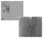 Transarterial Embolization for Upper Gastrointestinal Bleeding in a Patient with Prior Gastrododenal Artery Ligation