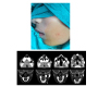 A Very Rare Case of First Branchial Cleft Sinus Outside Triangle of Triglia