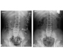 Numerous Sharp Foreign Body Ingestion and Spontaneous Expulsion Without any Complications