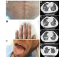 Dyskeratosis Congenita with Pulmonary Fibrosis