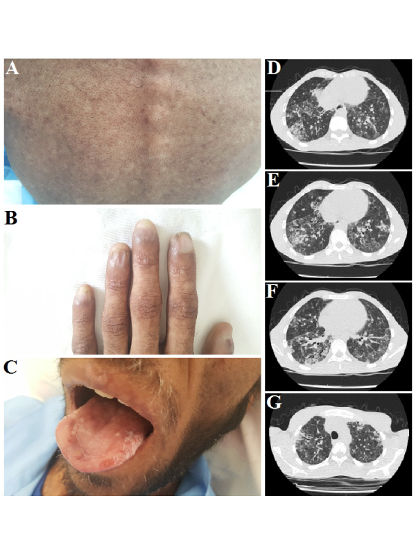 Dyskeratosis Congenita with Pulmonary Fibrosis