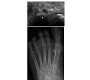 Ultrasonographic Assessment of the Foot Pseudotumoural Soft Tissue Lesions