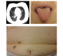 Recurrent Nasal Epistaxis, Osler-Weber-Rendu Syndrome