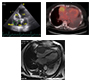 Atrial Mass in Multiple Myeloma – An Unusual Presentation